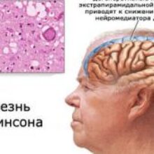 Неврологи обнаружили новое средство против болезни Паркинсона