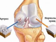 Артроз коленного сустава (гонартроз)