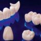 Цирконий или металлокерамика? Что выбрать, объясняет ортопед круглосуточной стоматологии «УстаДент»