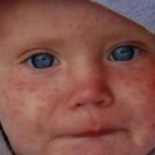 В Минздраве заявили о росте заболеваемости корью