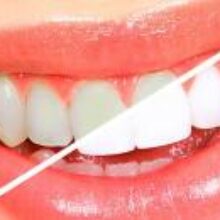 4 главных минуса отбеливания зубов