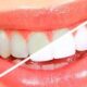 4 главных минуса отбеливания зубов