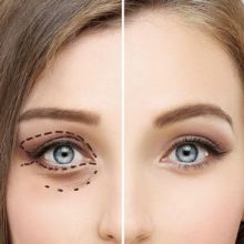 В каких случаях применяется блефаропластика лазерная?
