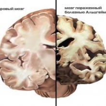 Как протекает болезнь Альцгеймера: от первой до седьмой стадии