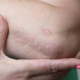 Названы симптомы псориаза и способы борьбы с кожным заболеванием