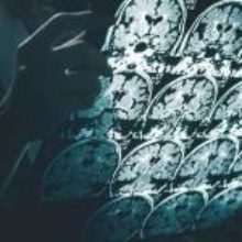 Медики предупредили о риске развития болезни Альцгеймера после COVID-19
