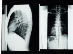 Туберкулез костей